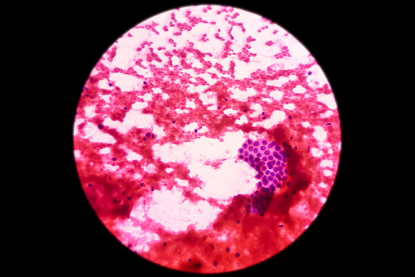 Hepatocellular carcinoma (hepatoma) malignant cells.