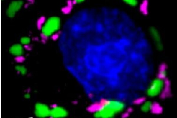In cells under duress, stress granules (in magenta) form outside of the nucleus (in blue). TDP-43 protein in green (arrow) that cannot bind to PolyADP ribose (PAR) builds up in large clumps distinct from stress granules. (Image: Leeanne McGurk, University of Pennsylvania; Molecular Cell)
