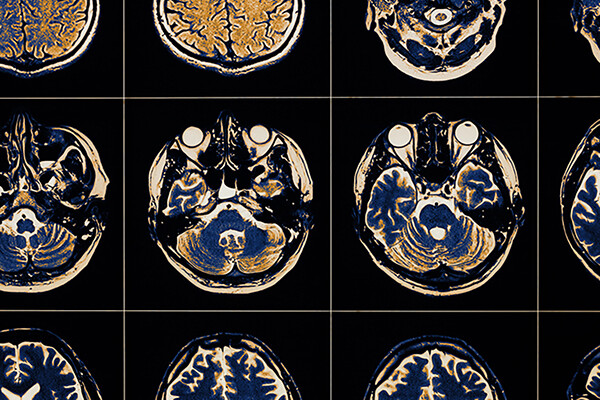 Grid of multiple brain scans