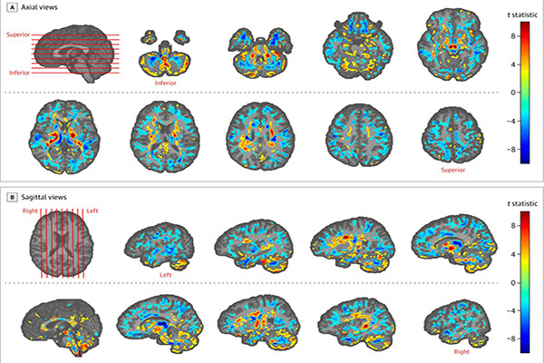 20 brain scans showing regions affected by neurological damage.