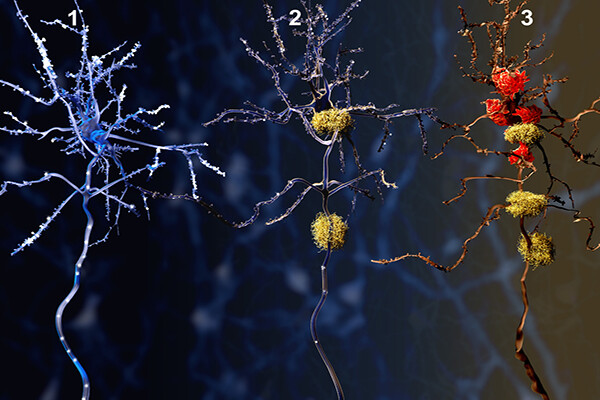 Three stages of Alzheimers portrayed by three scans of neurons