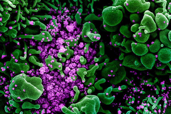 Colorized scanning electron micrograph of an apoptotic cell (green) heavily infected with SARS-COV-2 virus particles (purple), isolated from a patient sample.
