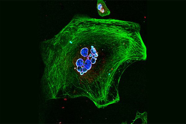 A microscopic look at an iPSC-cardiomyocyte harboring an LMNA mutation.