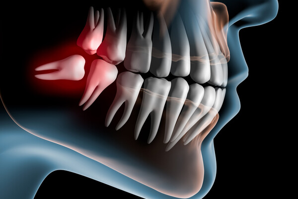 Rendering of a lengthwise wisdom tooth in the lower jaw.