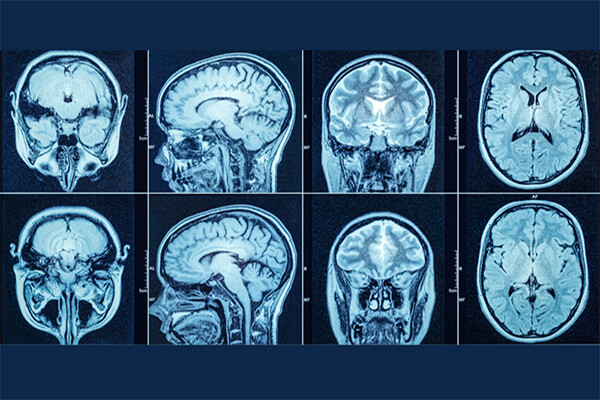 Grid of eight brain scans.