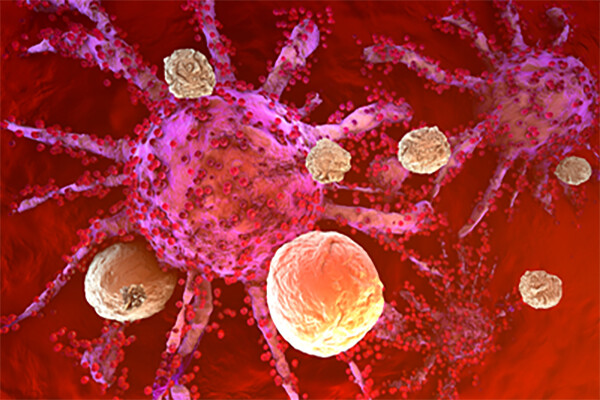 A cancer cell being attacked by CAR T cells.