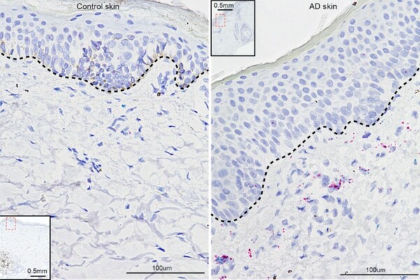 In two panels labeled "control skin" and "AD skin" stained cells show how inflammation is present in patients with atopic dermatitis