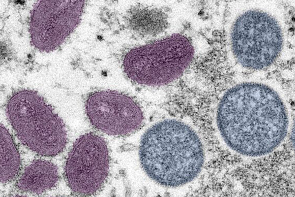 Microscopic view of monkeypox cells.