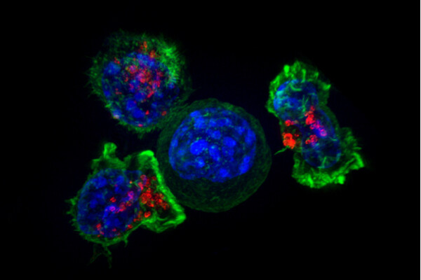 Fluorescent microscopic image of three T cells surrounding a cancer cell