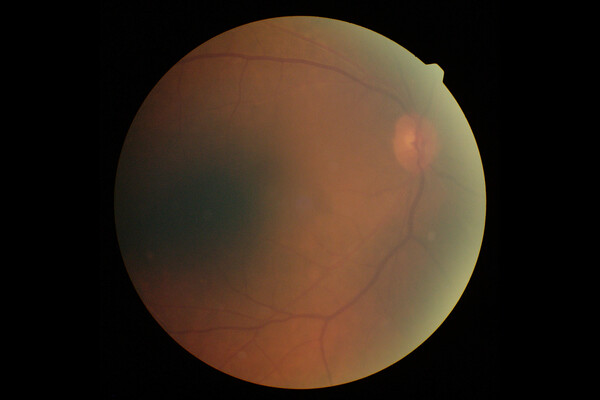 Microscopic view of a retina.