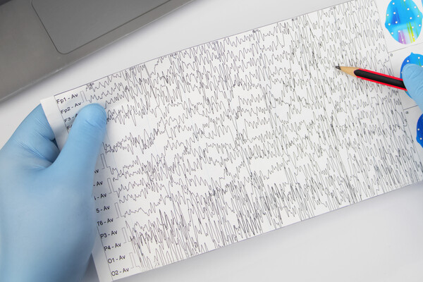 A neurologist examines an encephalogram of a patient’s brain.