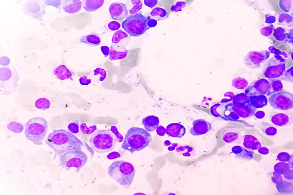Microscopic view of bone marrow slide showing multiple myeloma, a type of bone marrow cancer.