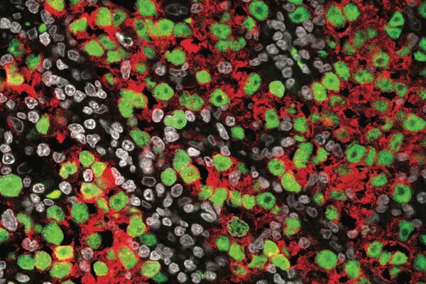 Microscopic image of seminoma tissue. The image shows green-stained cells representing early-stage germ cells, red-stained areas indicating high gene activity linked to cancer growth, and gray-stained nuclei of various cells