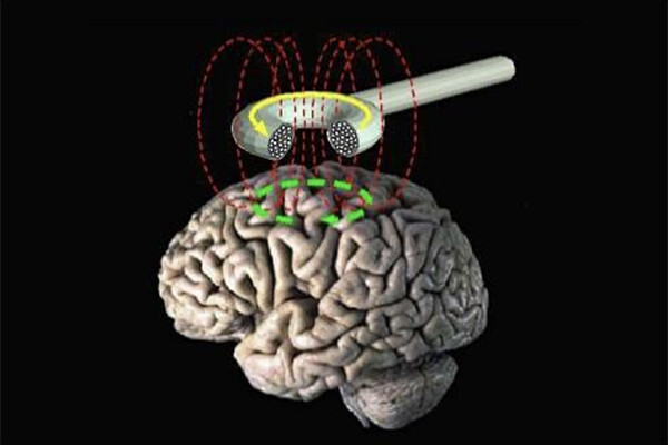 A transcranial magnetic stimulation tool hovering over a human brain model.
