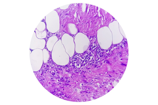 Microscopic view of granulomatous tissue.