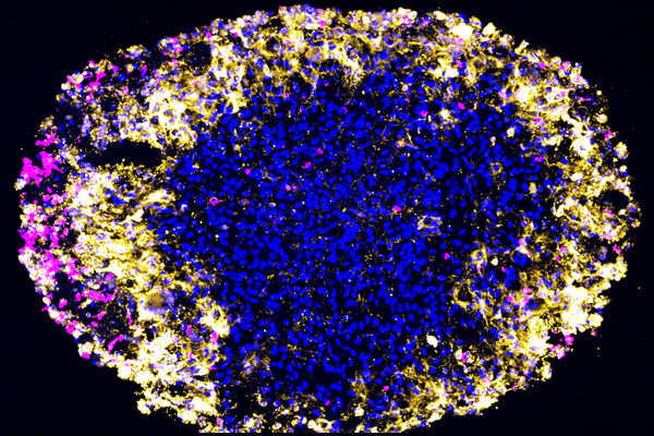 Microscopic view of a glioblastoma organoid.