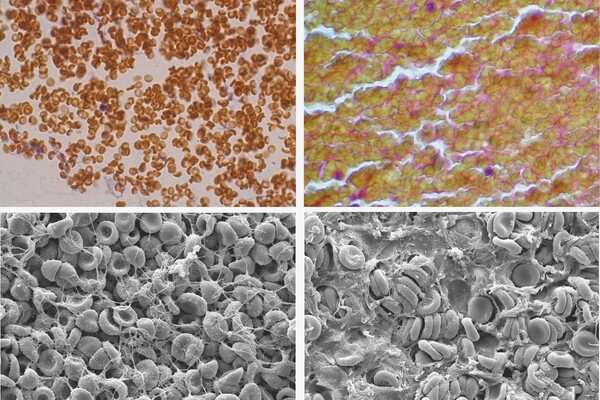 Four microscopic views of red blood cells.