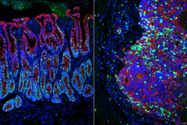 Immunofluorescent view of a normal colon on the left and a colon tumor on the right.