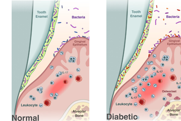 Diabetes oral microbiome