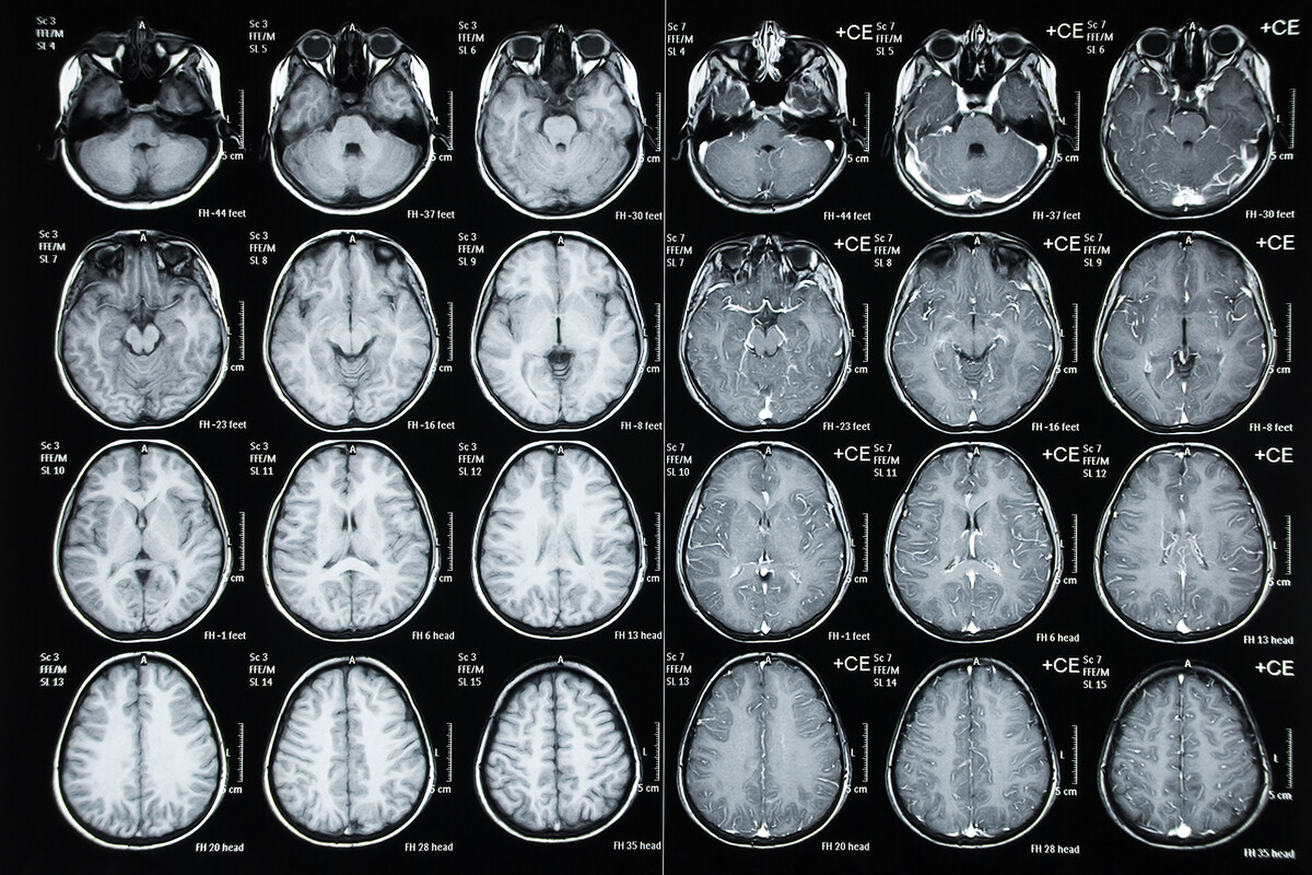 Sheet of a child’s brain scans.