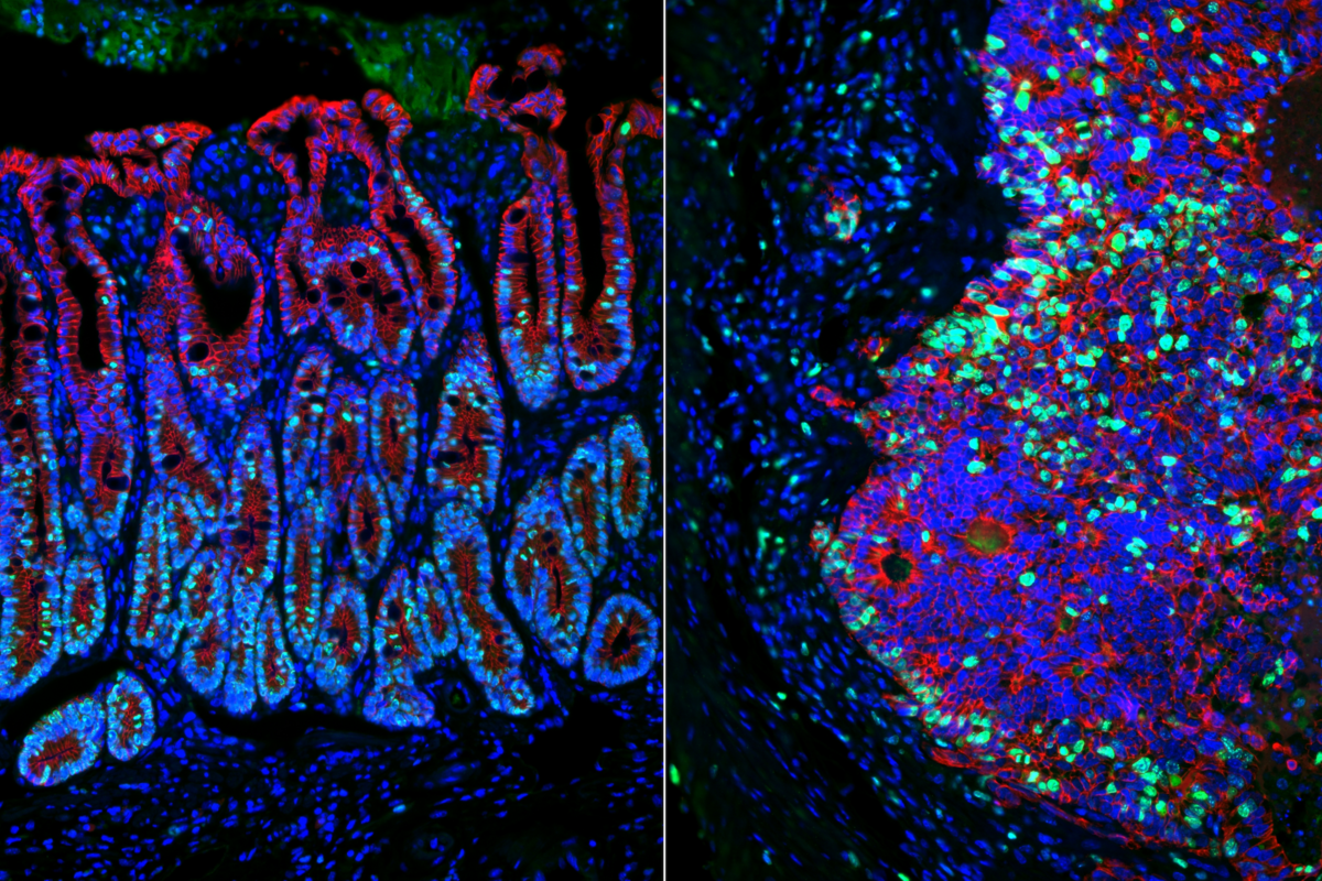 Immunofluorescent view of a normal colon on the left and a colon tumor on the right.